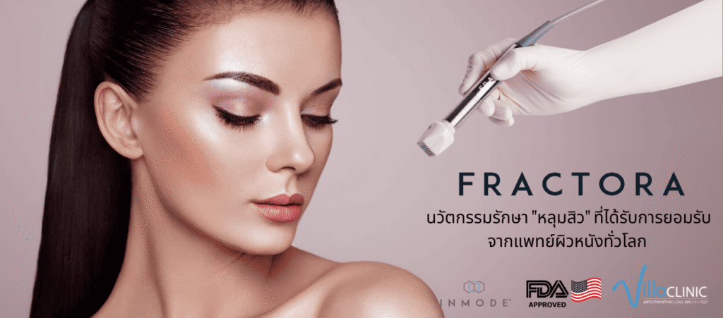 Villa Clinic คลินิกรักษาสิว ลงลึกทุกปัญหา เคลียร์สิว ฝ้า และรอยแดงเด่นชัดให้ดูจางลง